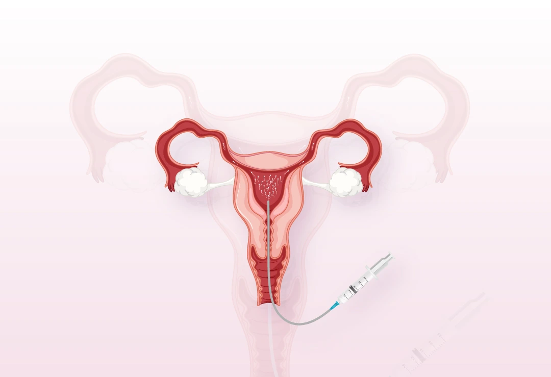 IUI